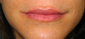 Lip Augmentation