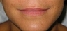 Lip Augmentation