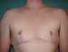 FTM chest masculinization in Chicagoland