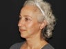 Facelift