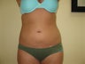 Liposuction of Abdomen and Waist