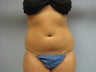 Liposuction of Abdomen and Waist