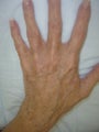 Hand Veins