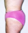 Tummy Tuck