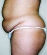 Tummy Tuck