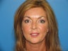 Eyelid Surgery