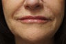 Lip Augmentation with Belotero