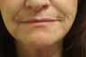 Lip Augmentation with Belotero