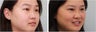 Double eyelid incisional surgery - before & 2 months post op