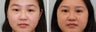 Double eyelid incisional surgery - before & 2 months post op