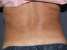 Liposculpture