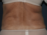 Liposculpture
