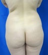 Brazilian Butt Lift (5 Liters Liposuction, 3 Liters into Buttocks)