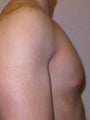 26 year old healthy male for chest reduction