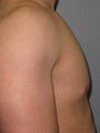 26 year old healthy male for chest reduction