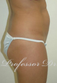 Butt Augmentation 