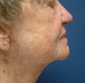 Facelift & CO2 Laser