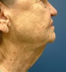 Facelift & CO2 Laser