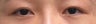 Bilateral Asian Eyelid Surgery