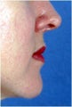 Lip Augmentatin with Testylane