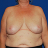 Breast Reduction