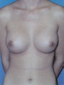 Breast Augmentation