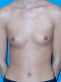 Breast Augmentation