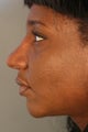African American female unhappy with prior rhinoplasty done elsewhere