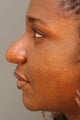 African American female unhappy with prior rhinoplasty done elsewhere