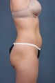 CoolSculpting 