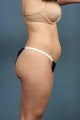 CoolSculpting 