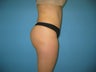 tummy tuck