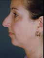 Female Primary Rhinoplasty 