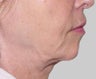 Exilis