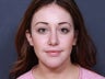 Nose Surgery