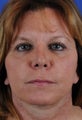 Revision Rhinoplasty