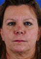 Revision Rhinoplasty