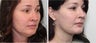 Short Incision Facelift & Platysmaplasty Before & After Photos Patient