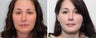 Short Incision Facelift & Platysmaplasty Before & After Photos Patient