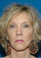 Brow Lift