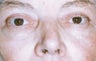 Blepharoplasty