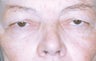 Blepharoplasty