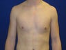 19 year old male complains of excess breast tissue