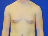 19 year old male complains of excess breast tissue