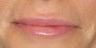 Lip Augmentation