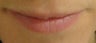 Lip Augmentation