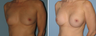 Breast Augmentation