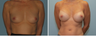 Breast Augmentation