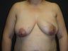 Breast reconstruction - Flap-based