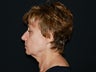 Facelift